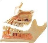 牙体病变模型